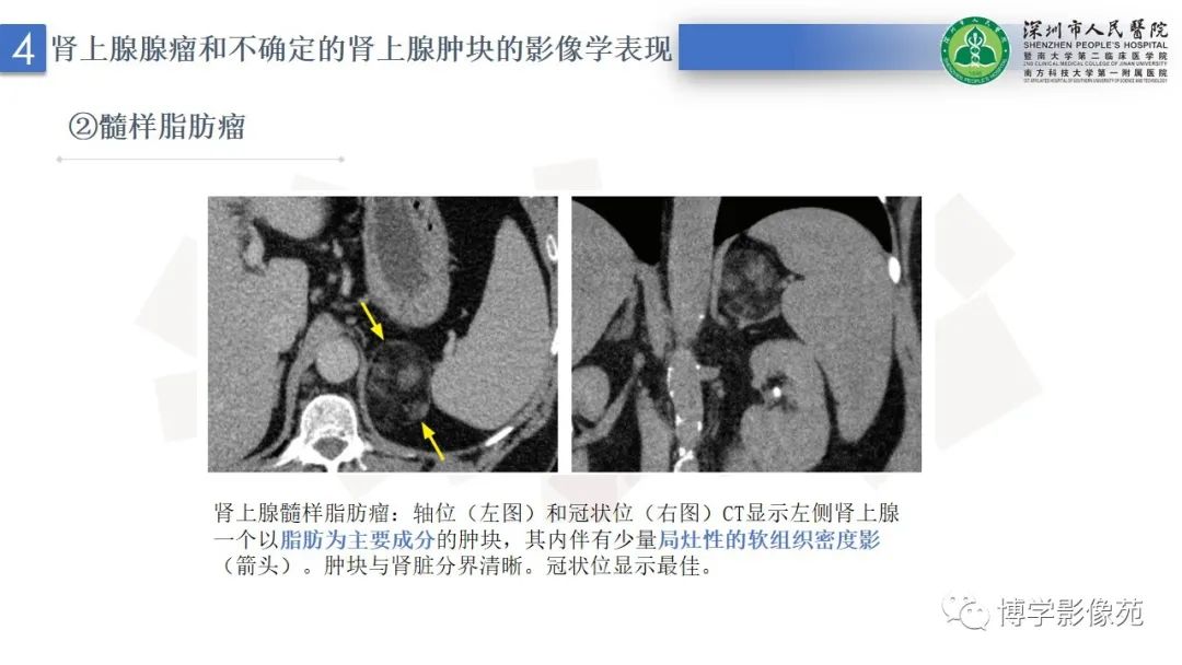 影像PPT - 【PPT】腹膜后间隙及肾上腺常见疾病影像表现-22