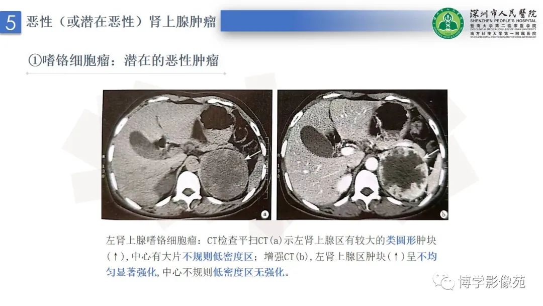 影像PPT - 【PPT】腹膜后间隙及肾上腺常见疾病影像表现-27
