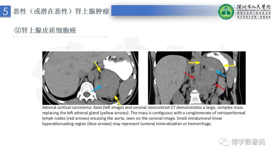 影像PPT - 【PPT】腹膜后间隙及肾上腺常见疾病影像表现-30