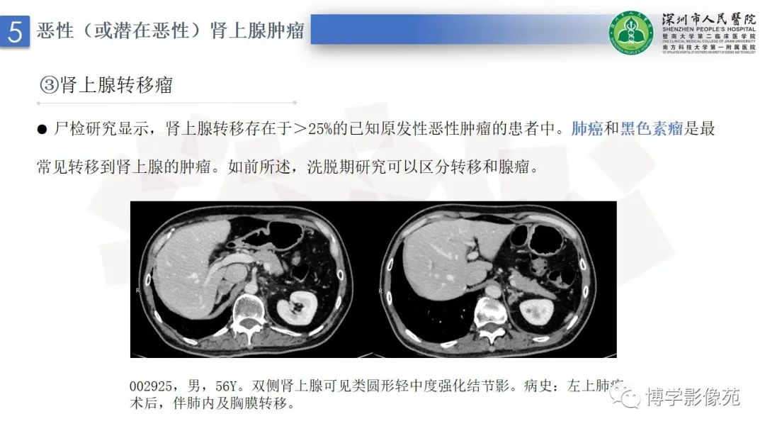 影像PPT - 【PPT】腹膜后间隙及肾上腺常见疾病影像表现-32