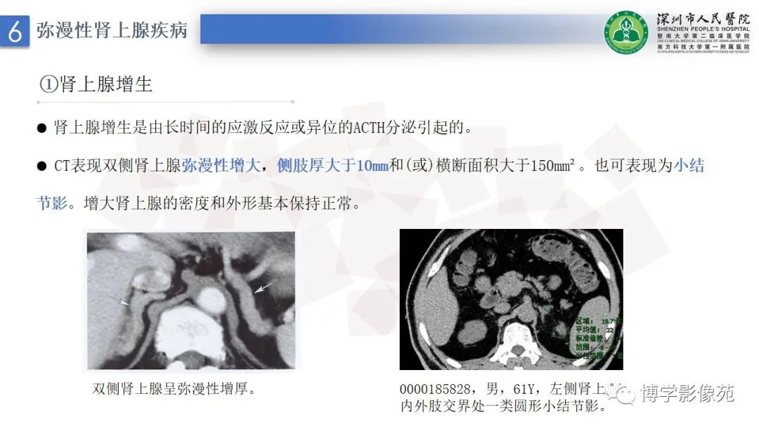 影像PPT - 【PPT】腹膜后间隙及肾上腺常见疾病影像表现-36