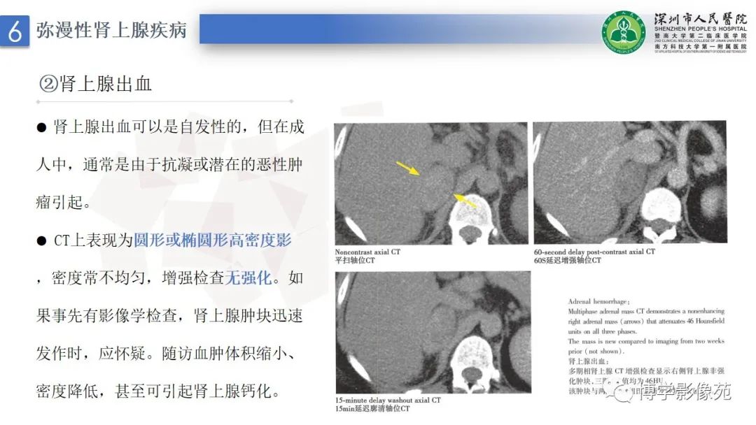 影像PPT - 【PPT】腹膜后间隙及肾上腺常见疾病影像表现-37