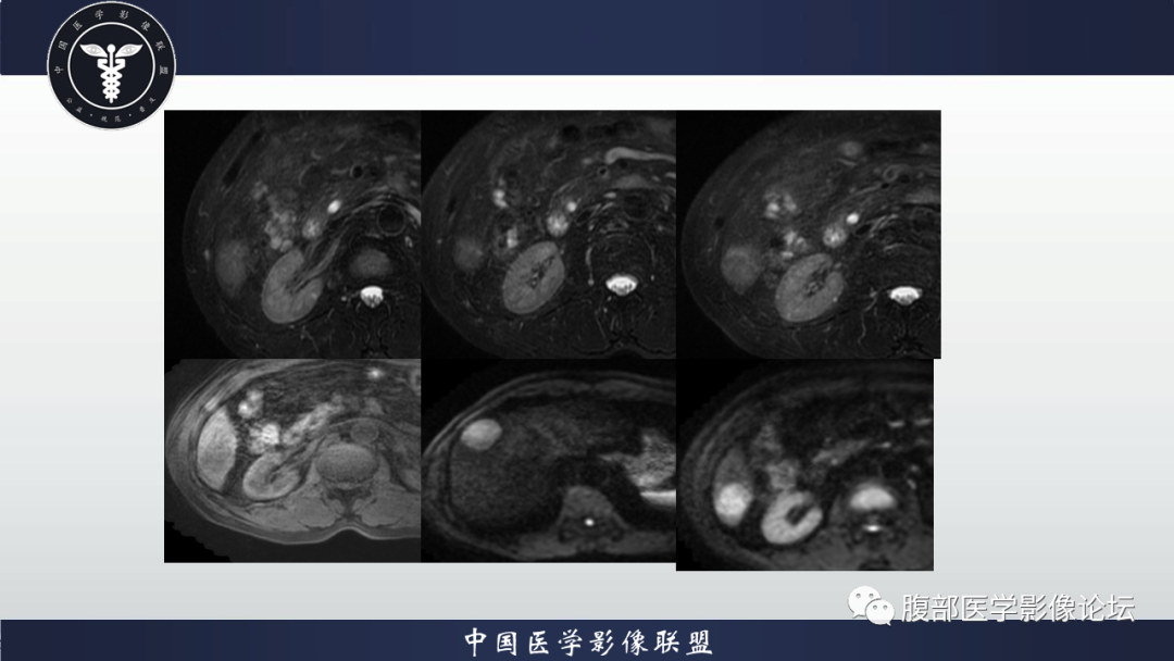 影像PPT - 【病例】肝细胞肝癌1例MR影像-4