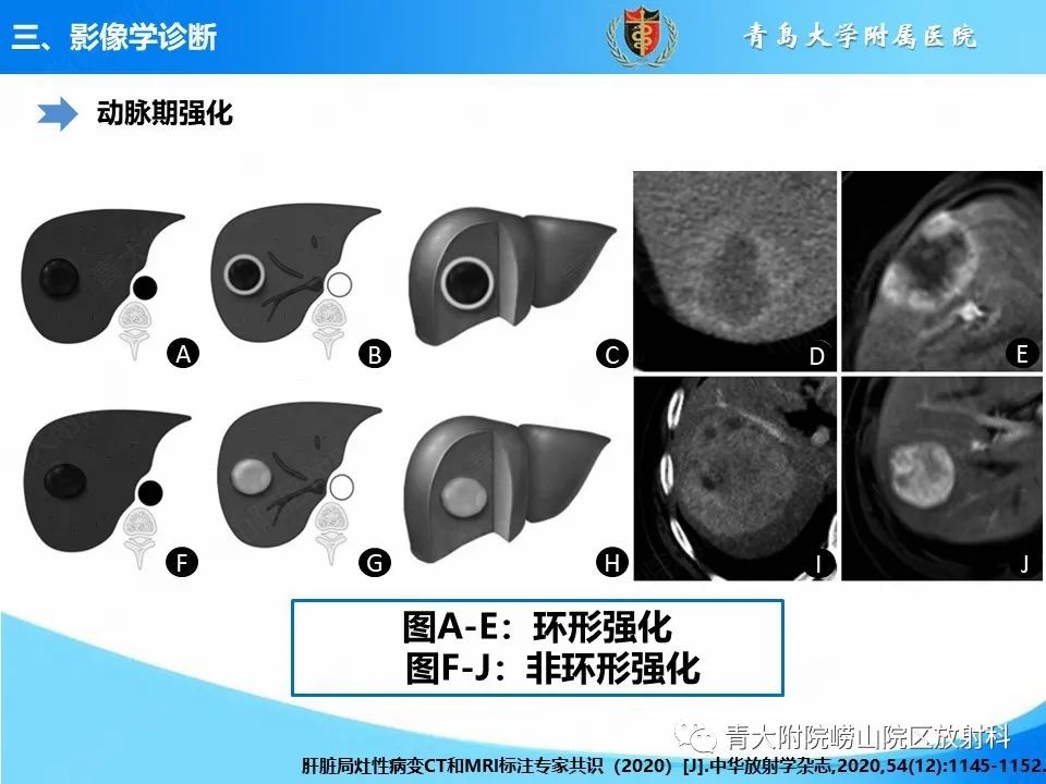 影像PPT - 【病例】肝细胞肝癌1例MR影像-15