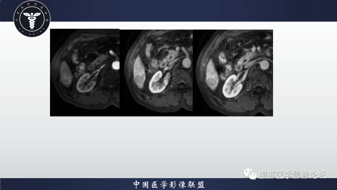 影像PPT - 【病例】肝细胞肝癌1例MR影像-6