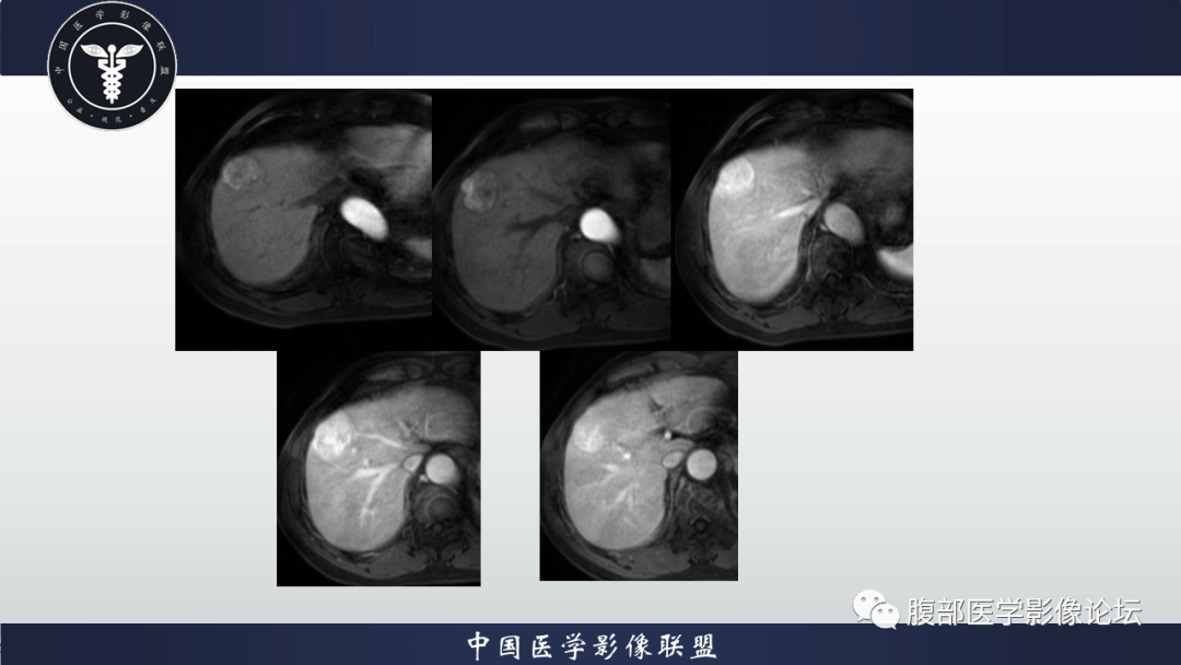 影像PPT - 【病例】肝细胞肝癌1例MR影像-5