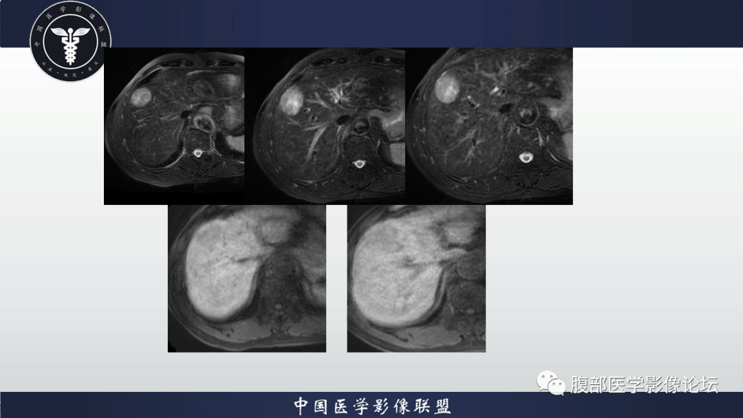 影像PPT - 【病例】肝细胞肝癌1例MR影像-3