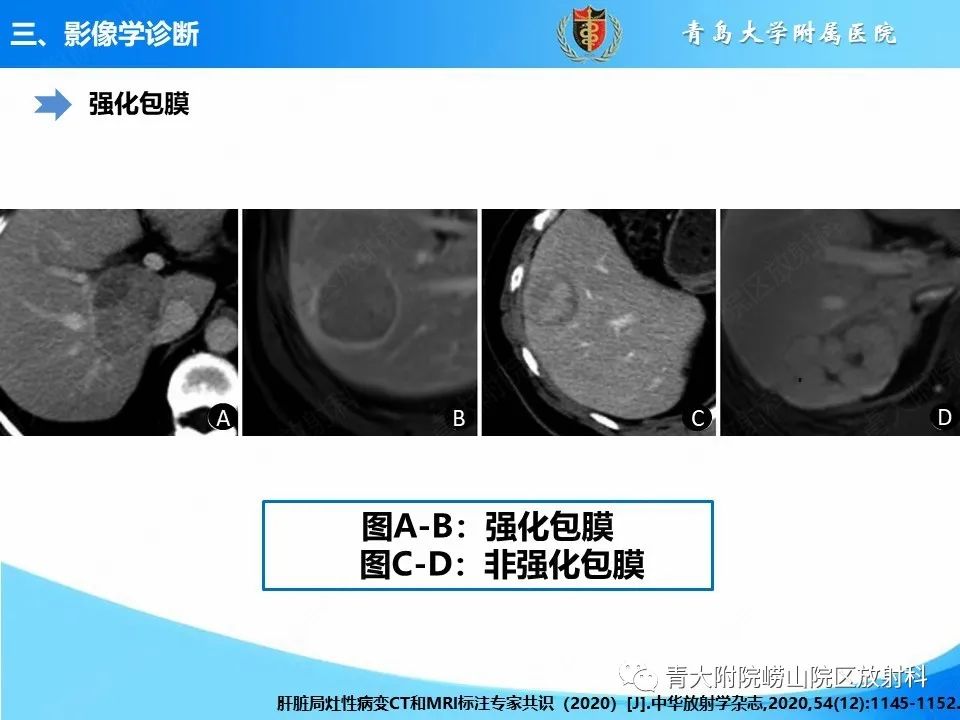 影像PPT - 【病例】肝细胞肝癌1例MR影像-19