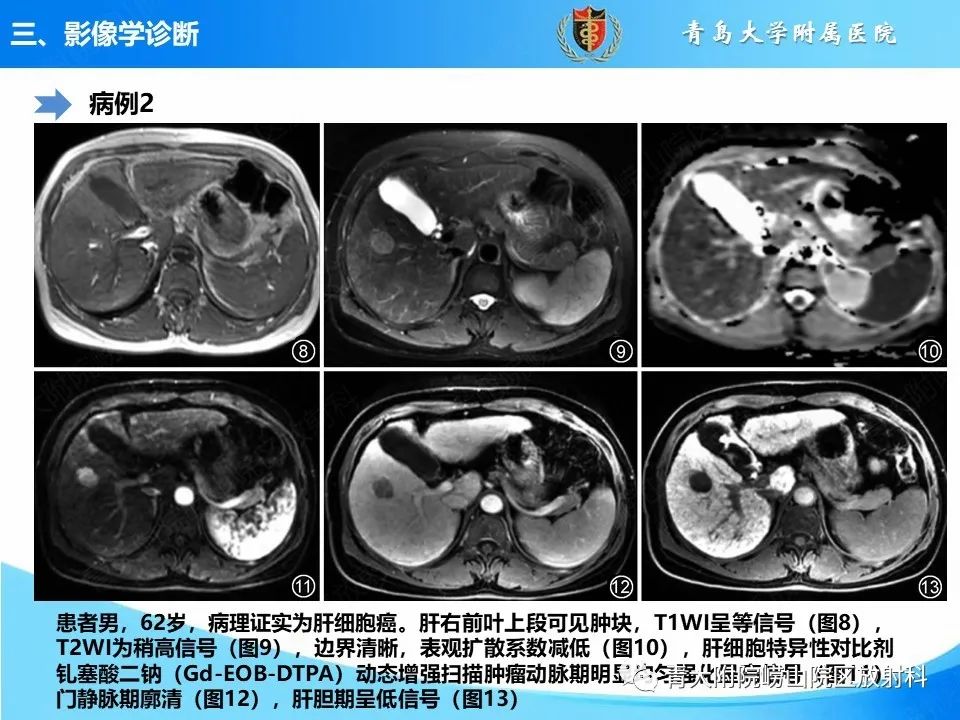 影像PPT - 【病例】肝细胞肝癌1例MR影像-23