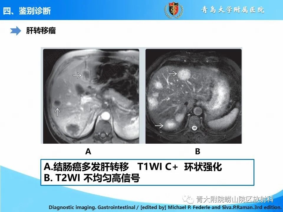 影像PPT - 【病例】肝细胞肝癌1例MR影像-29