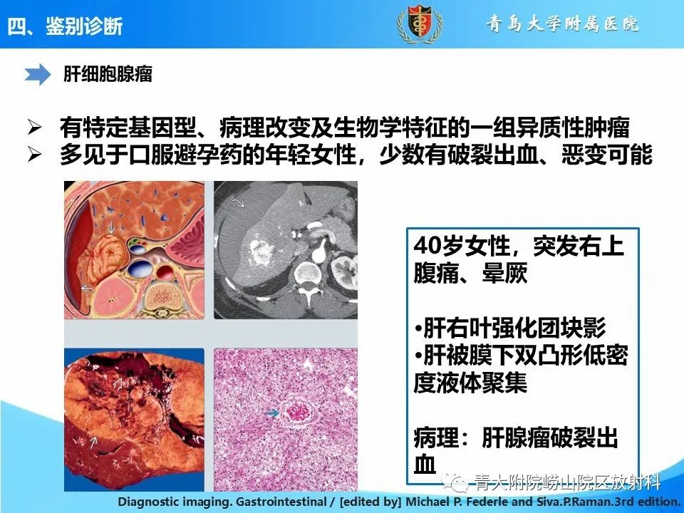 影像PPT - 【病例】肝细胞肝癌1例MR影像-32