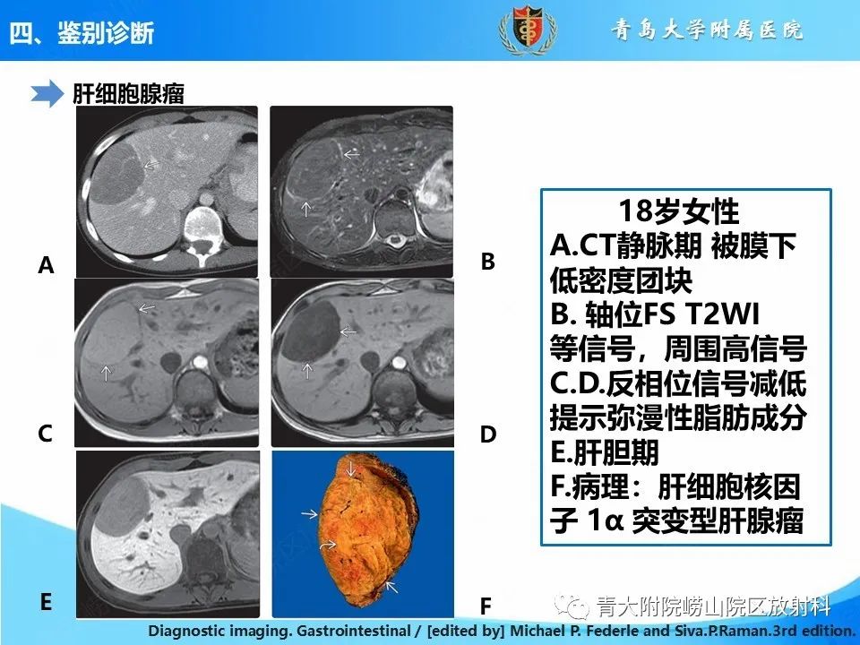 影像PPT - 【病例】肝细胞肝癌1例MR影像-34
