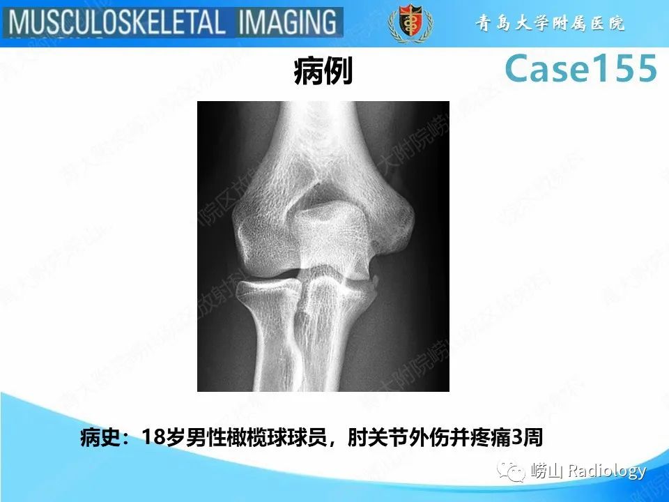 影像PPT - 【PPT】尺侧副韧带撕裂-2