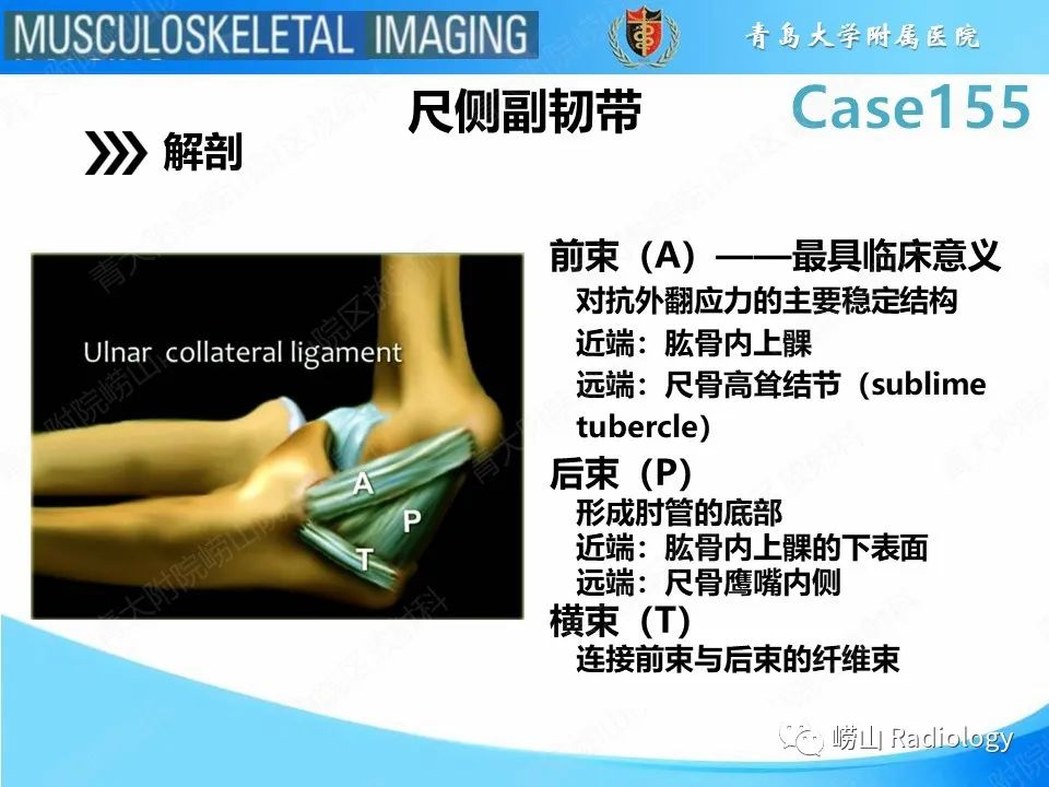 影像PPT - 【PPT】尺侧副韧带撕裂-8