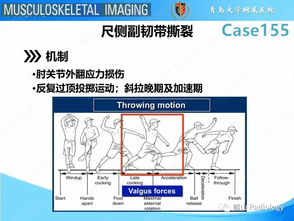 影像PPT - 【PPT】尺侧副韧带撕裂-11