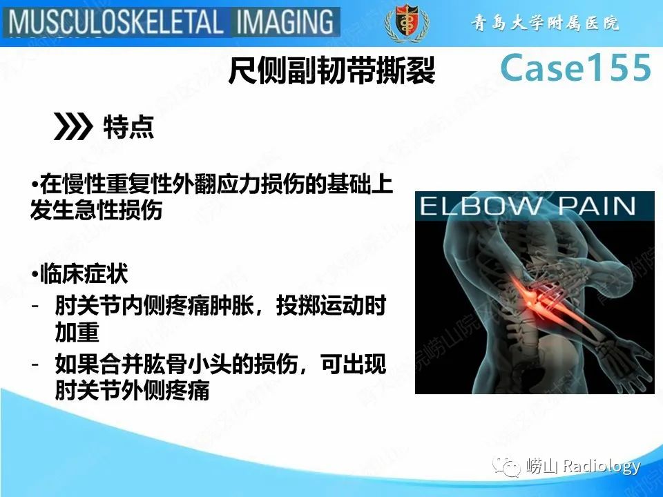 影像PPT - 【PPT】尺侧副韧带撕裂-12