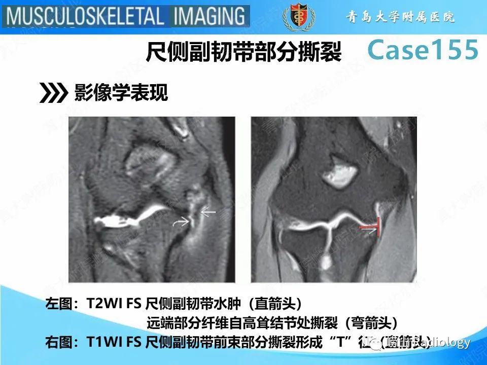 影像PPT - 【PPT】尺侧副韧带撕裂-14