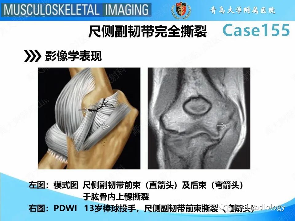 影像PPT - 【PPT】尺侧副韧带撕裂-15