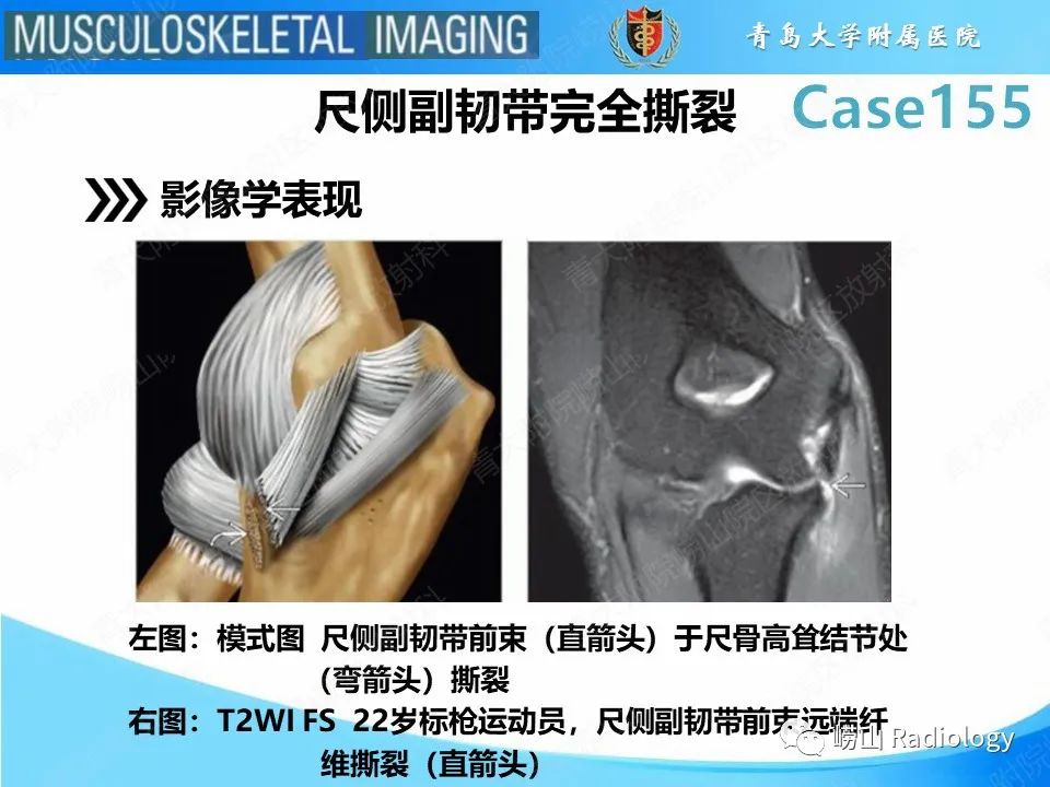 影像PPT - 【PPT】尺侧副韧带撕裂-16