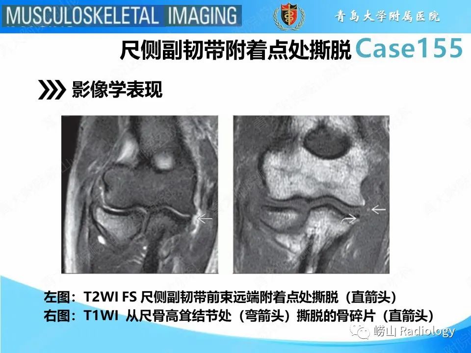 影像PPT - 【PPT】尺侧副韧带撕裂-17