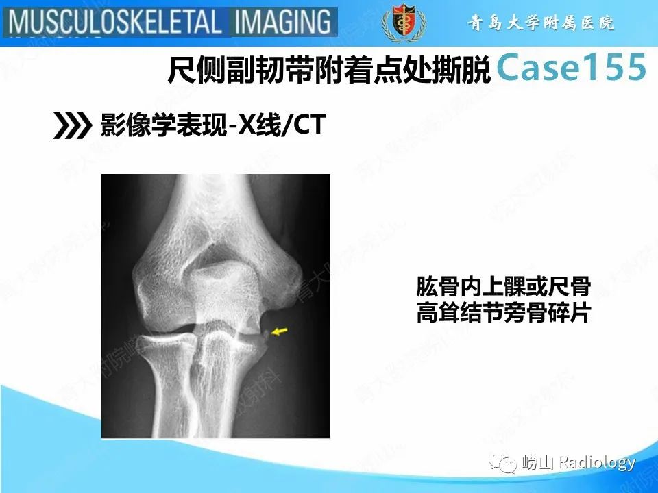 影像PPT - 【PPT】尺侧副韧带撕裂-18