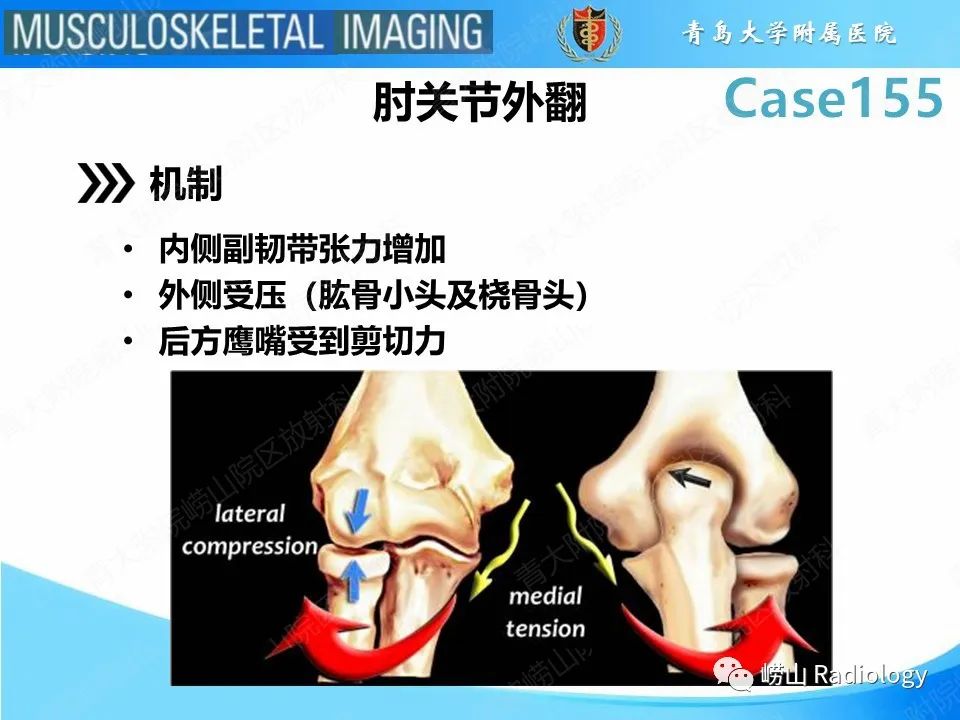 影像PPT - 【PPT】尺侧副韧带撕裂-21