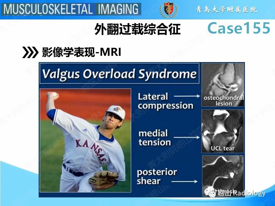影像PPT - 【PPT】尺侧副韧带撕裂-22
