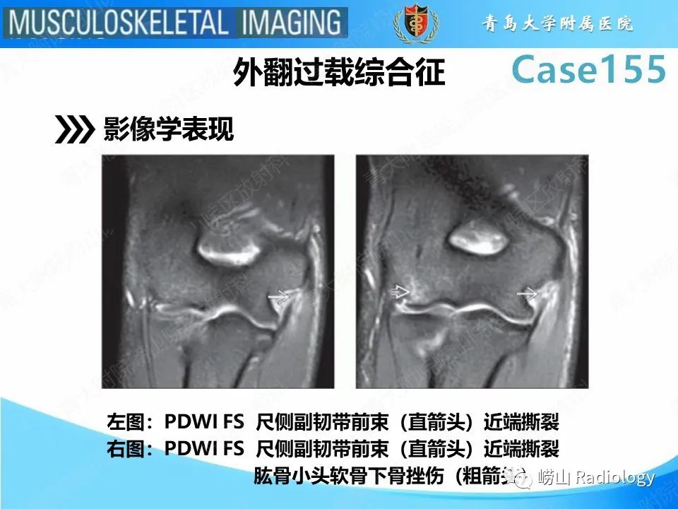 影像PPT - 【PPT】尺侧副韧带撕裂-23