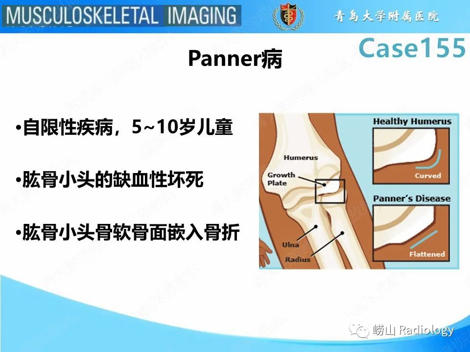 影像PPT - 【PPT】尺侧副韧带撕裂-24