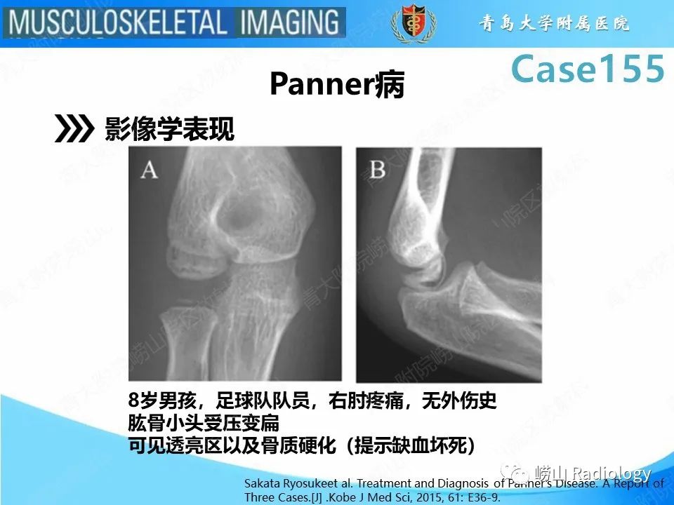 影像PPT - 【PPT】尺侧副韧带撕裂-25