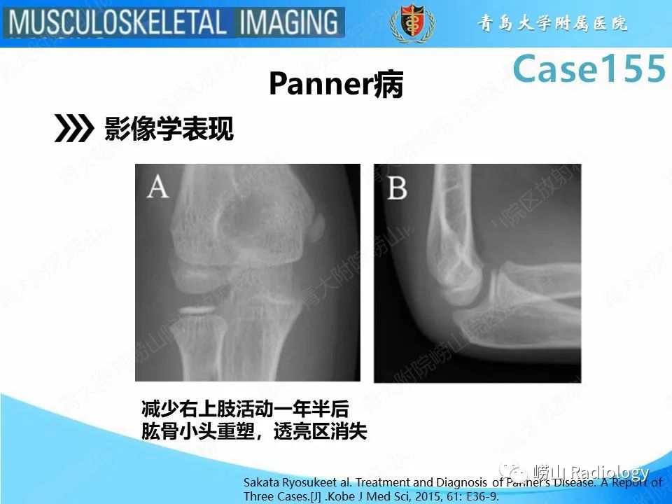 影像PPT - 【PPT】尺侧副韧带撕裂-26