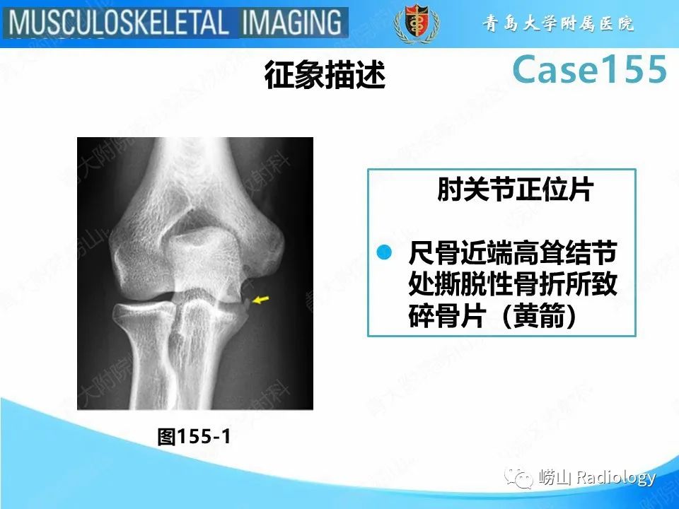 影像PPT - 【PPT】尺侧副韧带撕裂-29