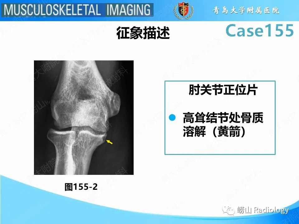 影像PPT - 【PPT】尺侧副韧带撕裂-30