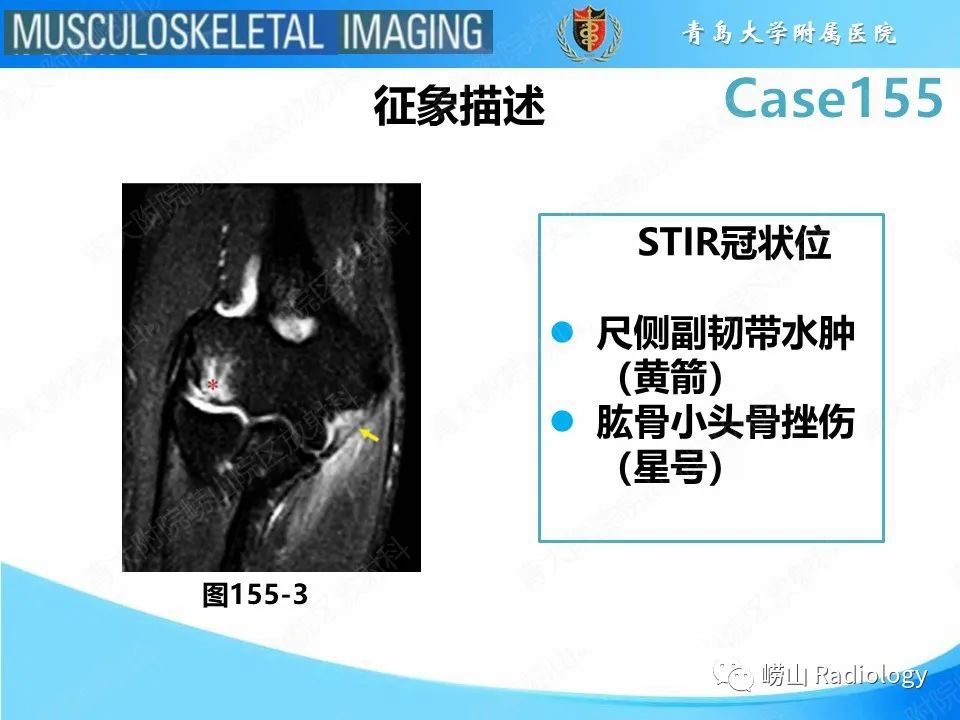 影像PPT - 【PPT】尺侧副韧带撕裂-31