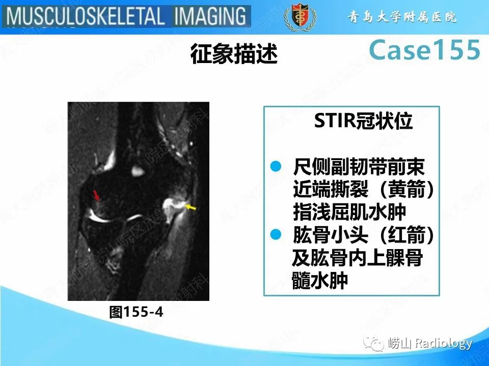 影像PPT - 【PPT】尺侧副韧带撕裂-32