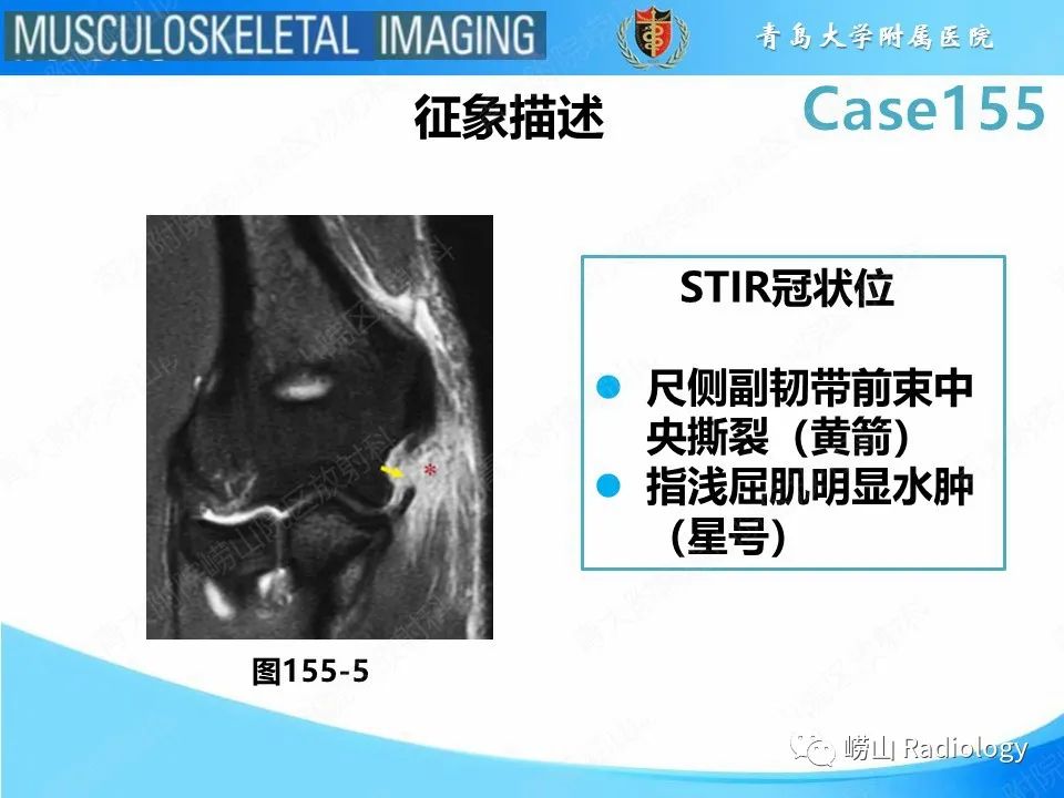 影像PPT - 【PPT】尺侧副韧带撕裂-33