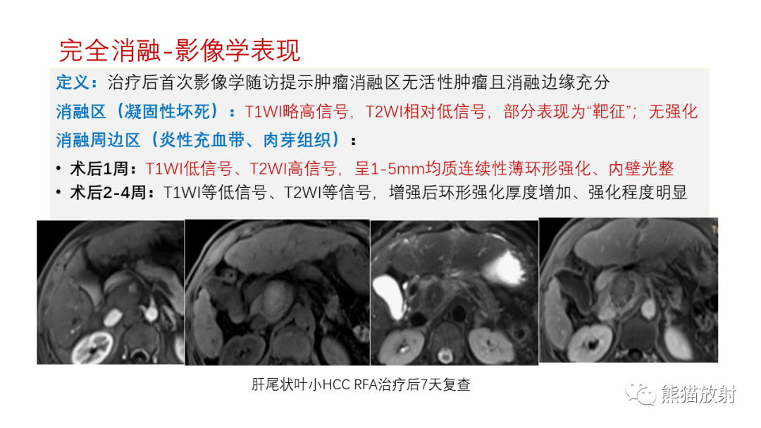 影像PPT - 【PPT】HCC热消融治疗后影像表现解读及报告标准-7