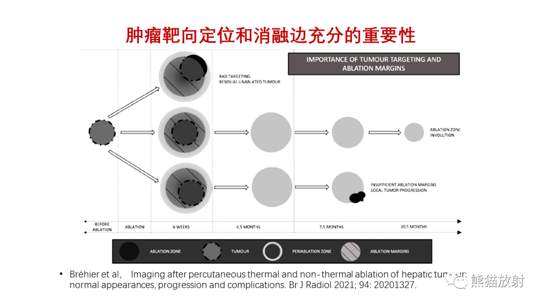影像PPT - 【PPT】HCC热消融治疗后影像表现解读及报告标准-6