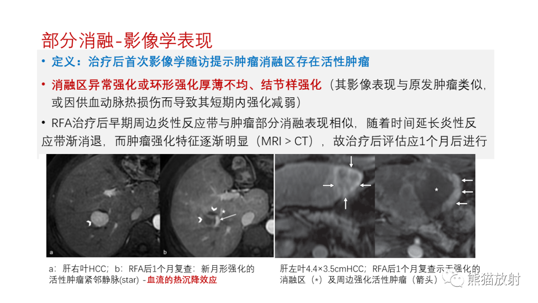 影像PPT - 【PPT】HCC热消融治疗后影像表现解读及报告标准-11