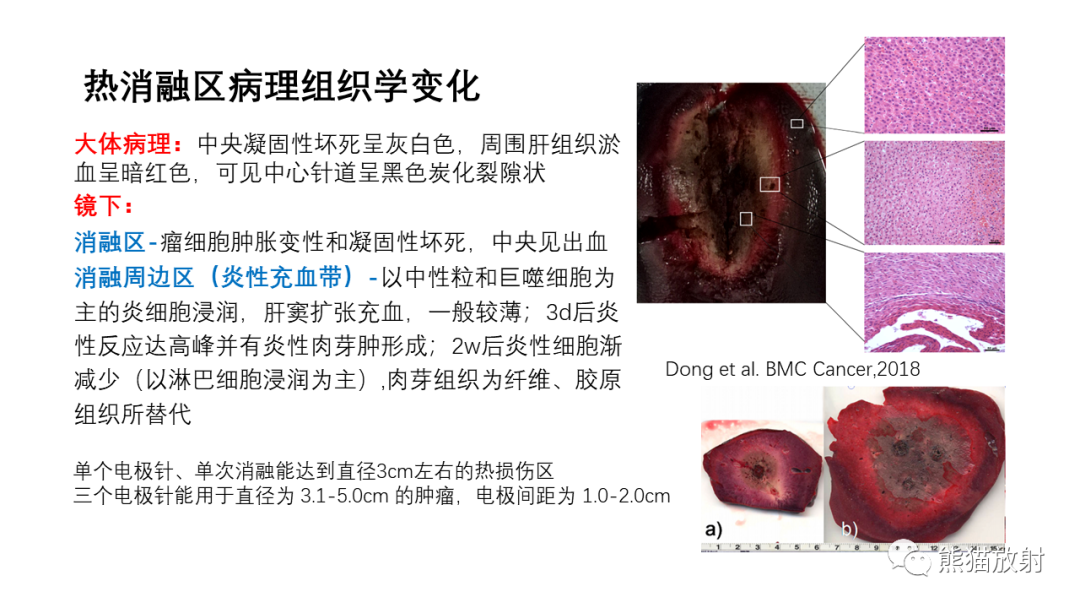影像PPT - 【PPT】HCC热消融治疗后影像表现解读及报告标准-4