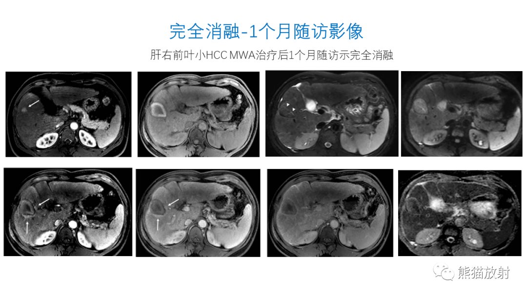 影像PPT - 【PPT】HCC热消融治疗后影像表现解读及报告标准-8