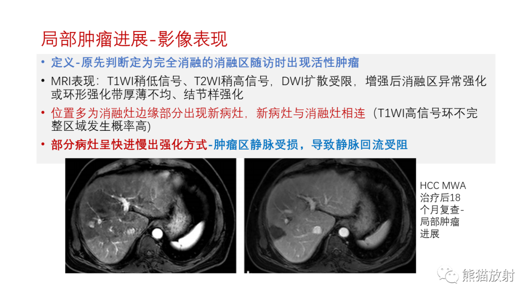 影像PPT - 【PPT】HCC热消融治疗后影像表现解读及报告标准-12