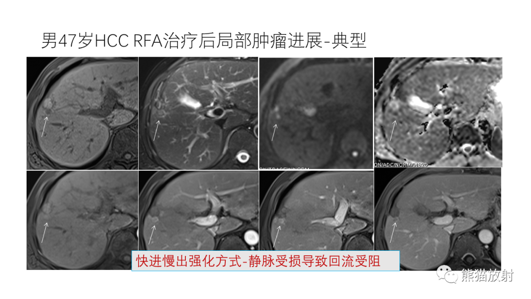 影像PPT - 【PPT】HCC热消融治疗后影像表现解读及报告标准-13