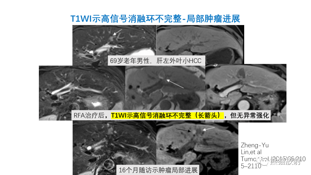 影像PPT - 【PPT】HCC热消融治疗后影像表现解读及报告标准-14