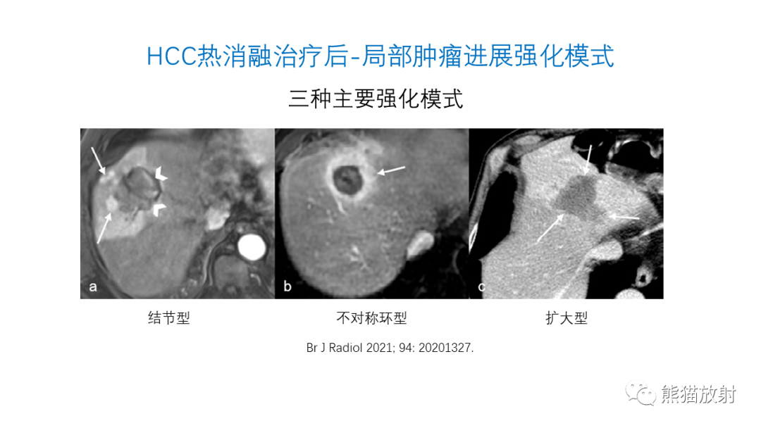 影像PPT - 【PPT】HCC热消融治疗后影像表现解读及报告标准-15
