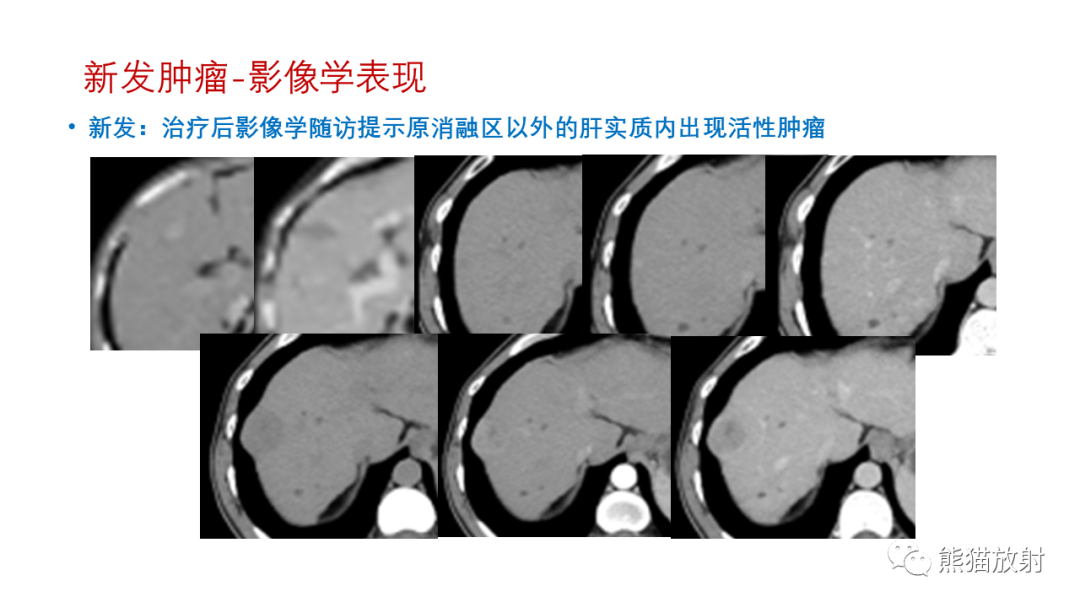 影像PPT - 【PPT】HCC热消融治疗后影像表现解读及报告标准-16