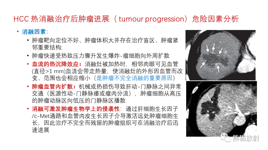 影像PPT - 【PPT】HCC热消融治疗后影像表现解读及报告标准-19