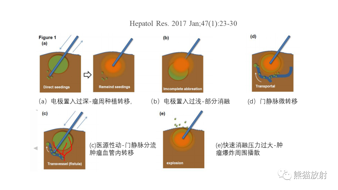 影像PPT - 【PPT】HCC热消融治疗后影像表现解读及报告标准-20