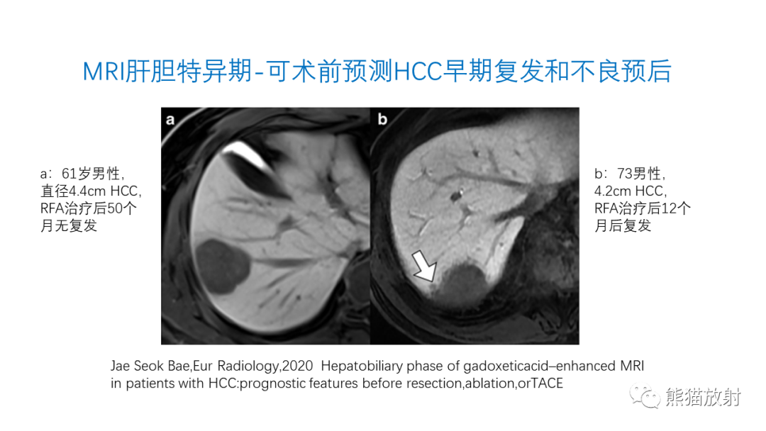 影像PPT - 【PPT】HCC热消融治疗后影像表现解读及报告标准-21