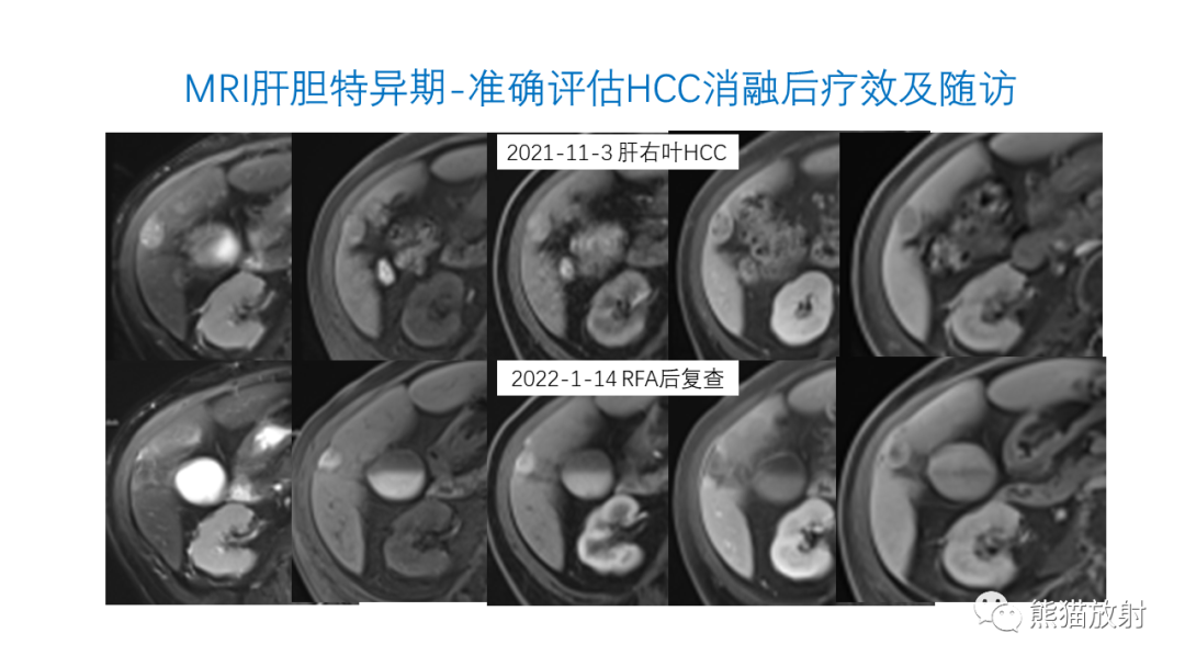 影像PPT - 【PPT】HCC热消融治疗后影像表现解读及报告标准-22